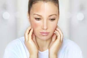facelift